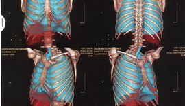 Laudo e imagens de tomografia mostram fraturas em costelas de Luiza Brunet