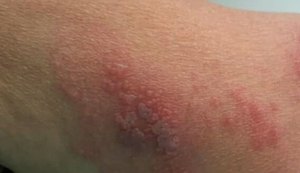O avanço da Herpes
