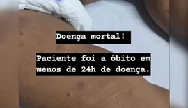 Ministério da Saúde virá para Maceió debater sobre ações de controle contra meningite