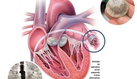 Cardiologia da Santa Casa de Maceió inova com próteses que podem evitar AVC