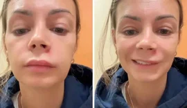 Mulher vai parar no pronto-socorro após espremer espinha no 'triângulo da morte''