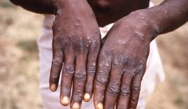 Varíola dos macacos: OMS alerta sobre cuidados durante transfusão de sangue