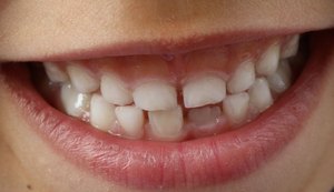 Células-tronco extraídas dos dentes de leite disponível em Maceió