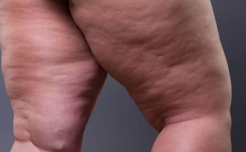 Lipedema: o que é a doença frequentemente confundida com obesidade e celulite