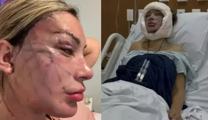 23 outra vez? Médicos reagem após Andressa Urach realizar cirurgia de rejuvenescimento