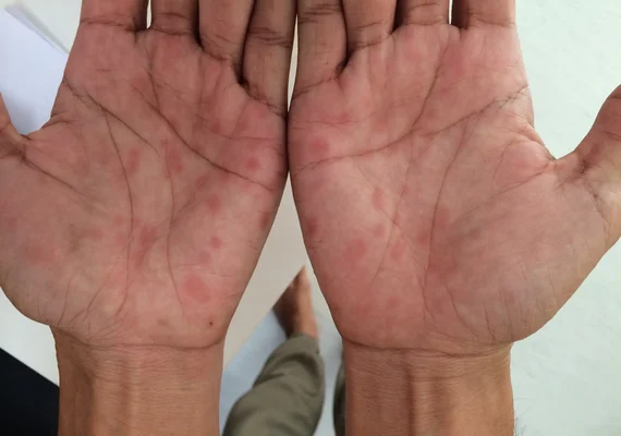 Casos de sífilis já superam todos registros de 2024