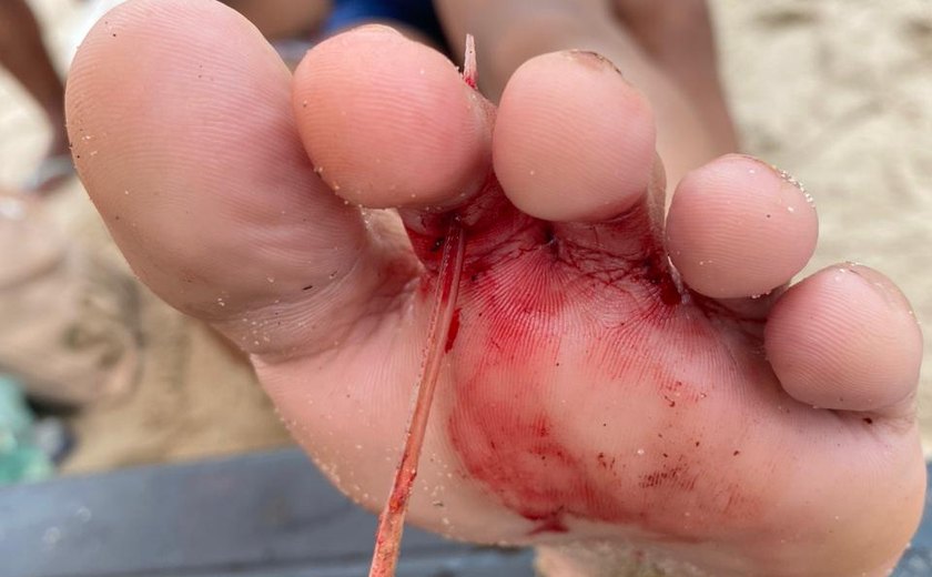 Menina de 10 anos fura dedo de um pé em ferrão de arraia na Praia de Pajuçara