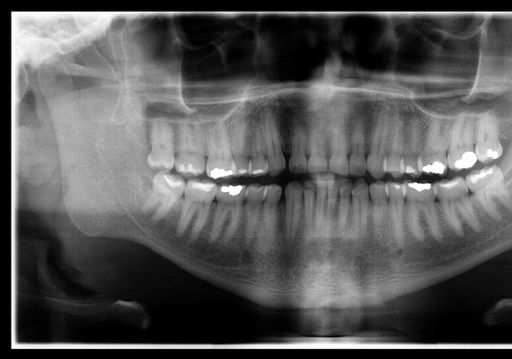 Corpo de enfermeiro do Mato Grosso é identificado após exame de odontologia legal
