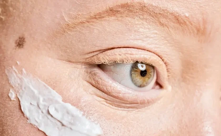 Maceió garante protetor solar gratuito para pessoas com albinismo