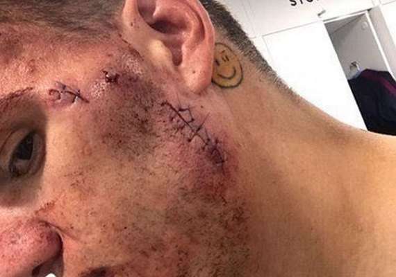 Ederson mostra corte costurado após solada de jogador do Liverpool