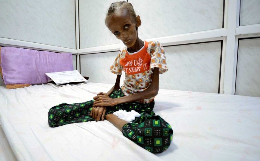 Unicef: uma criança morre a cada 10 minutos no Iêmen por desnutrição