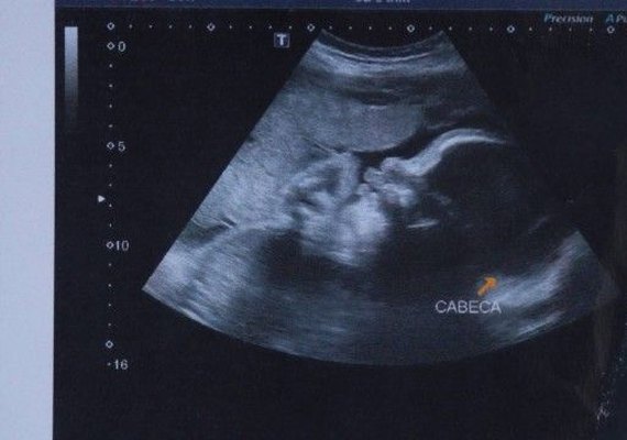 Morre no RJ bebê que foi baleado quando ainda estava na barriga da mãe