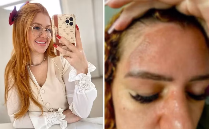 Empresária tem queimadura grave após panela de pressão explodir