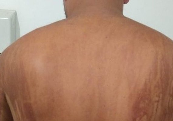 Após banho de mar, homem sente corpo queimar e procura ambulatório