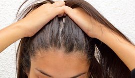 Dermatologista explica diferença entre queda de cabelo e calvície
