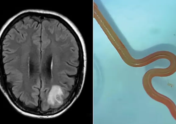 Verme de 8 centímetros parasita de cobra píton é encontrado em cérebro de mulher de 64 anos