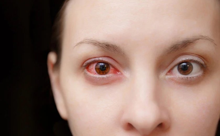Conjuntivite: oftalmologista orienta sobre prevenção e quando buscar atendimento
