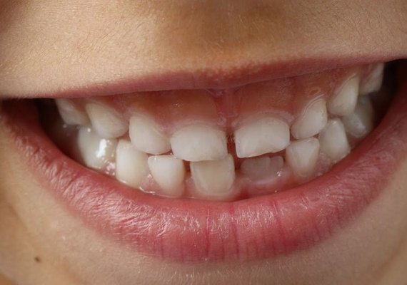 Células-tronco extraídas dos dentes de leite disponível em Maceió