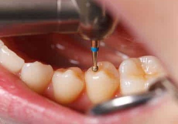 Mais de 2 bilhões de pessoas têm cáries no mundo