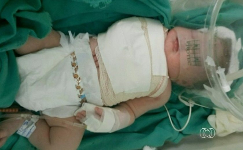 Bebê tem braço e clavícula quebrados durante parto em hospital público