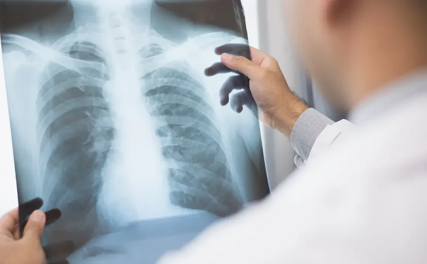 Anvisa aprova novo medicamento para câncer de pulmão avançado