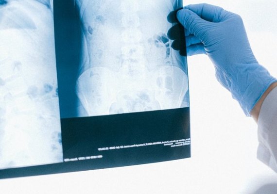 Tuberculose: diagnóstico precoce e tratamento adequado são essenciais