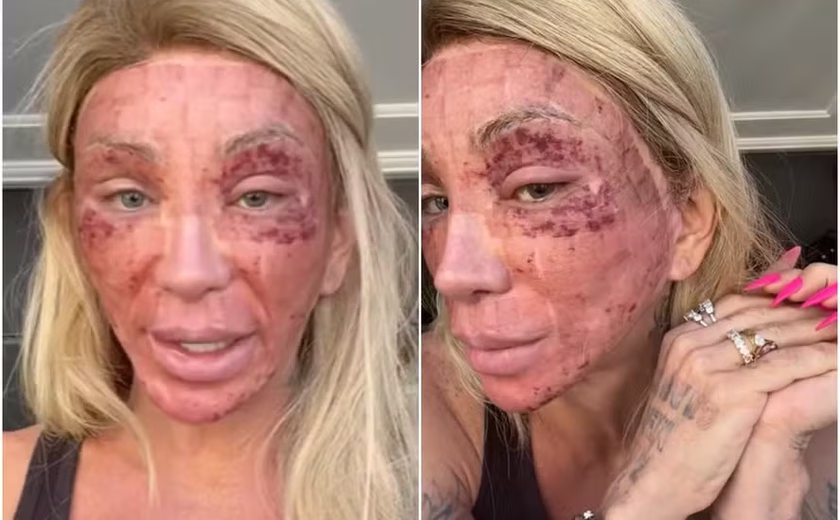 O que aconteceu com o rosto de Maya Massafera? Lesões impressionam