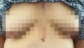 Idoso desenvolve 'seios' após tomar medicamento para condição cardíaca