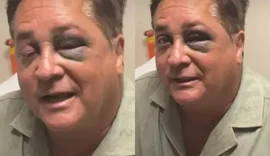 Cantor Leonardo surge de olho roxo após acidente e esposa relata susto em passeio
