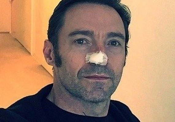 Hugh Jackman é submetido a novo tratamento contra câncer de pele