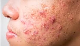 Acne em diferentes fases da vida: entenda