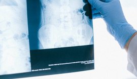 Tuberculose: diagnóstico precoce e tratamento adequado são essenciais