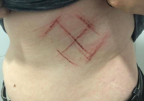 Jovem é ferida com canivete por usar camisa com 'ele não'; suástica foi marcada na pele