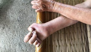 Hanseníase: mais que um problema de saúde, um rombo para a previdência