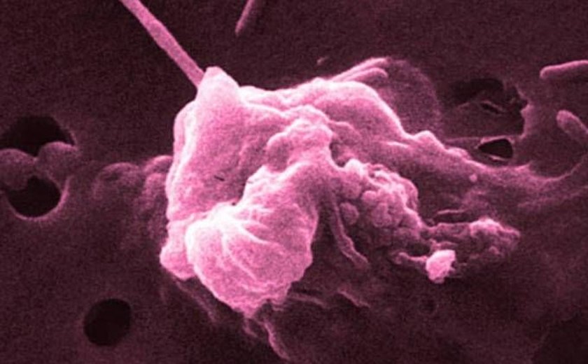 Descoberta nova forma de detecção de câncer no pâncreas