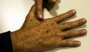 Desinformação sobre câncer de pele afeta diagnóstico, diz instituição