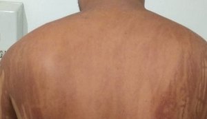 Após banho de mar, homem sente corpo queimar e procura ambulatório