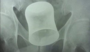 Idoso tem copo de metal preso ao ânus após ser assaltado e violentado