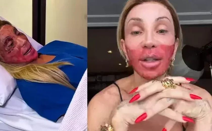 Maya Massafera deixa rosto em carne viva e motivo vem à tona