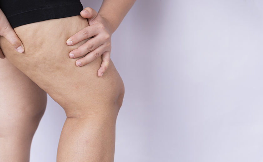 Lipedema ganha visibilidade durante o Junho Roxo e alerta para a importância do diagnóstico