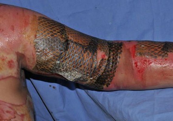Médicos usam pele do peixe tilápia para tratar queimaduras