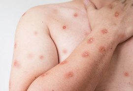 Sobe para 140 número de casos confirmados de Mpox no país