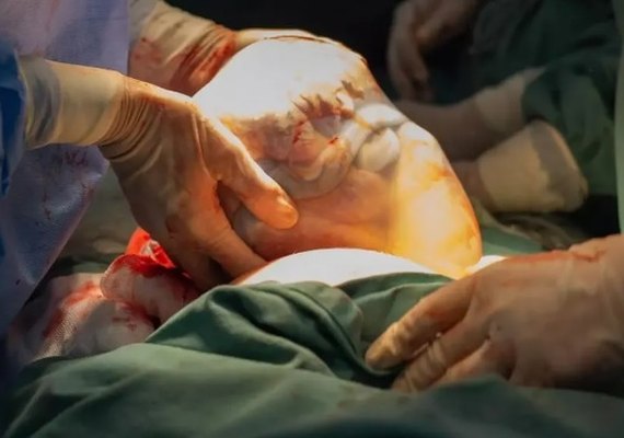 Mulher dá à luz gêmeos, e um nasce empelicado