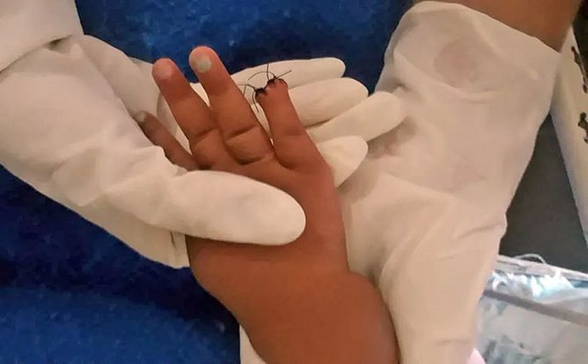 Bebê internada por picada na testa tem parte do dedo amputada após corte na hora de tirar atadura