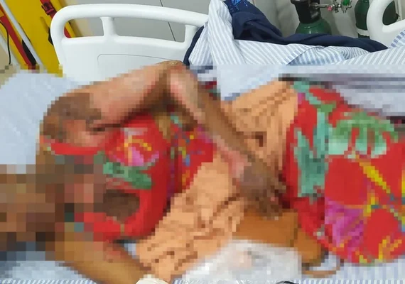 Mulher sofre queimaduras graves em várias partes do corpo em tentativa de feminicídio