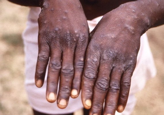 Por que os casos de varíola do macaco estão se espalhando na Europa e nos EUA?