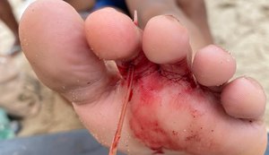 Menina de 10 anos fura dedo de um pé em ferrão de arraia na Praia de Pajuçara