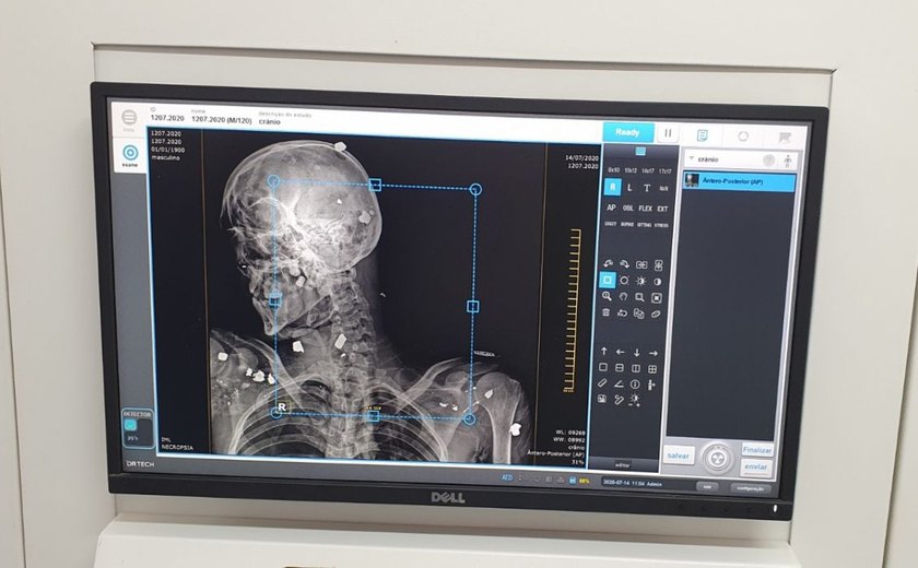 IML de Maceió começa a operar novo software para exames com scanner corporal