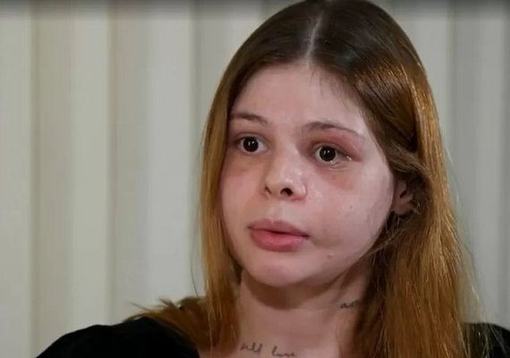 Médica agredida por ex-namorado fisiculturista perde visão parcial e tem rosto 'desfigurado'