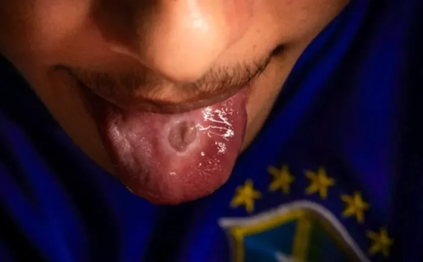 Vítima de pais de santo teve língua e mãos queimadas com colher quente
